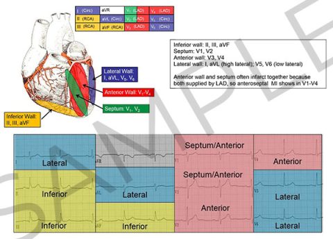 12 Lead ECG Reference Chart (Printed) – Cardiovascular Nursing ...