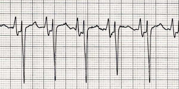 Cardiac Arrhythmia Interpretation Courses – Cardiovascular Nursing 