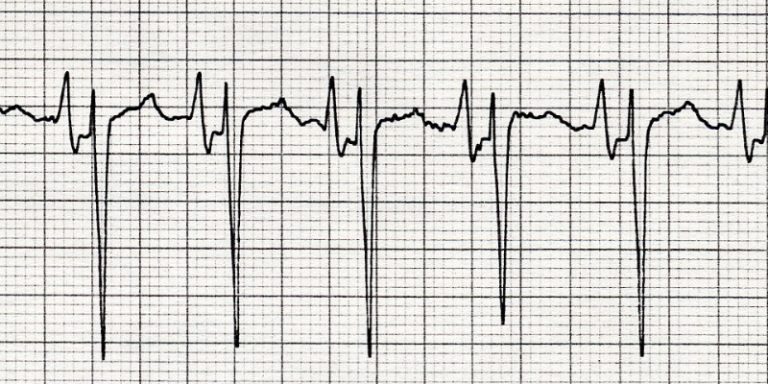 Cardiac Arrhythmia Interpretation Courses – Cardiovascular Nursing ...